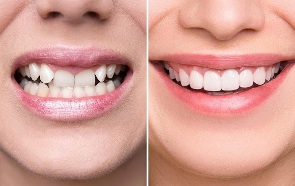 Răng chó là răng gì? Tính cách, vận mệnh và tướng số của người răng chó 8 Phương pháp bọc răng sứ là lựa chọn tối ưu khi muốn cải thiện hình dáng, kích thước, màu sắc của răng nanh lệch lạc