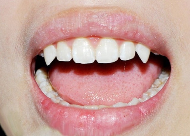 Răng chó là răng gì? Tính cách, vận mệnh và tướng số của người răng chó 1 Răng chó là một trong các loại răng trong cung răng của con người