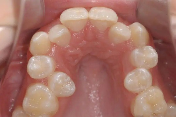 Gây chen chúc, xô lệch các răng kế cận Gây chen chúc, xô lệch các răng kế cận