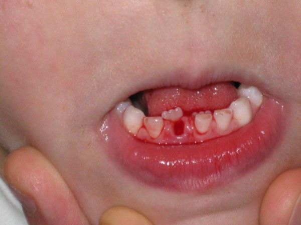 Hướng dẫn khắc phục răng mọc lẫy an toàn, đúng chuẩn nha khoa Hướng dẫn khắc phục răng mọc lẫy an toàn, đúng chuẩn nha khoa