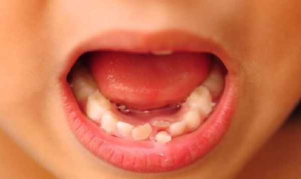 Biện pháp ngăn ngừa răng mọc lẫy hiệu quả từ sớm Biện pháp ngăn ngừa răng mọc lẫy hiệu quả từ sớm