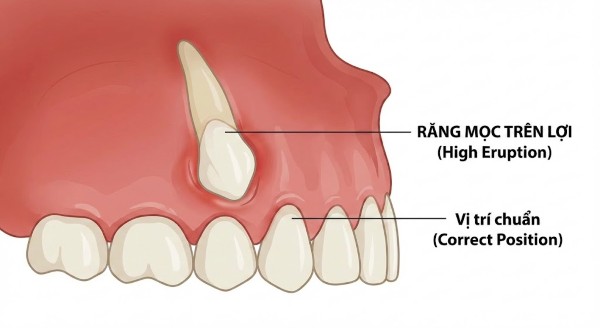 Răng mọc trên lợi là gì? Răng mọc trên lợi là gì?