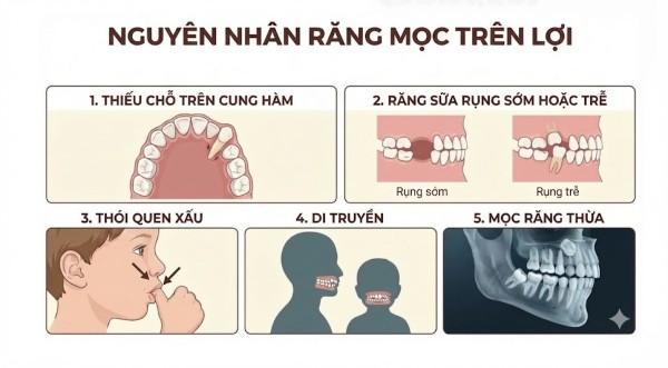 Nguyên nhân khiến răng mọc trên lợi Nguyên nhân khiến răng mọc trên lợi