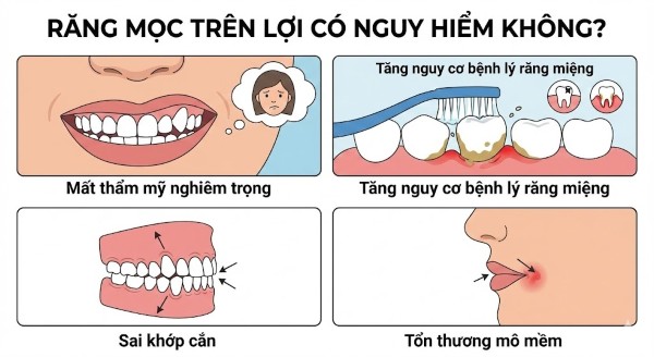 Răng mọc trên lợi có nguy hiểm không? Răng mọc trên lợi có nguy hiểm không?