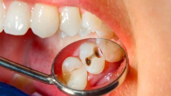 Các vấn đề thường gặp ở răng số 5 Các vấn đề thường gặp ở răng số 5