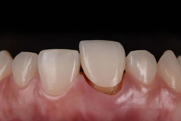 Răng sứ bị lỏng là gì? Răng sứ bị lỏng là gì?