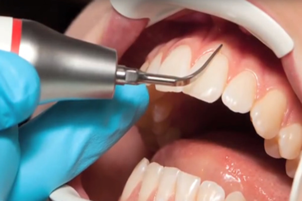 Điều trị viêm nướu – nha chu Điều trị viêm nướu – nha chu