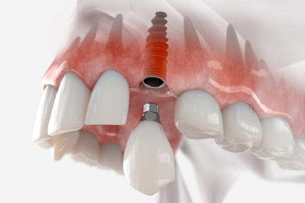 Trồng răng implant nếu trụ răng thật bị hư hỏng Trồng răng implant nếu trụ răng thật bị hư hỏng