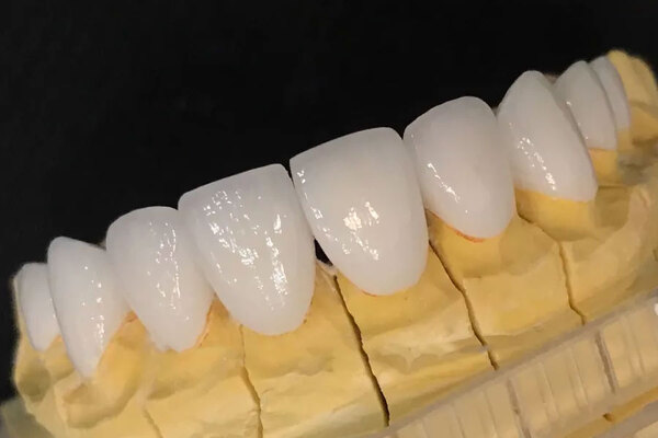 Răng sứ không kim loại giá bao nhiêu? Răng sứ không kim loại giá bao nhiêu?