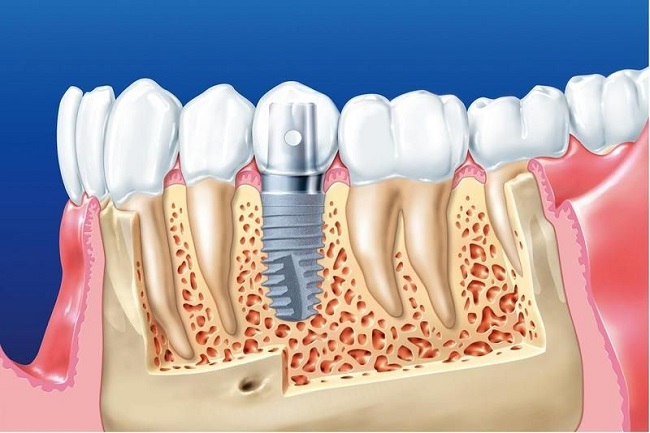 15 Tuổi trồng răng được không? Độ tuổi nào cấy implant tốt? 2 Implant cần xương hàm ổn định để tích hợp