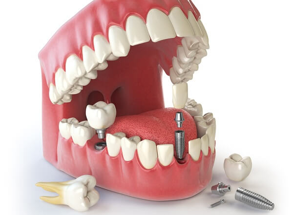 15 Tuổi trồng răng được không? Độ tuổi nào cấy implant tốt? 5 Không tự ý trồng Implant khi chưa có chỉ định bác sĩ