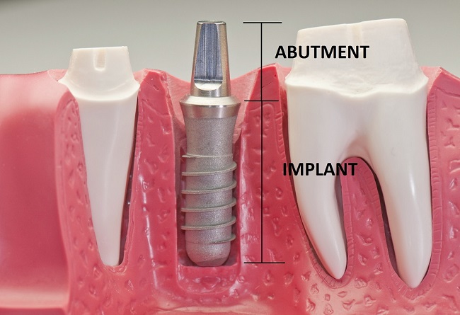 Abutment Implant là gì? Vai trò và các loại Abutment phổ biến 2 Thiếu abutment, quá trình phục hình không thể thực hiện