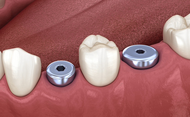 Abutment Implant là gì? Vai trò và các loại Abutment phổ biến 4 Healing abutment