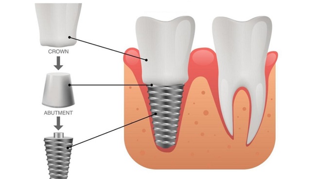 Abutment Implant là gì? Vai trò và các loại Abutment phổ biến 5 Abutment vững chắc giúp mão sứ không lung lay