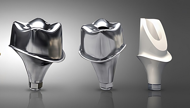 Abutment Implant là gì? Vai trò và các loại Abutment phổ biến 6 Lựa chọn Abutment phù hợp tình trạng xương hàm