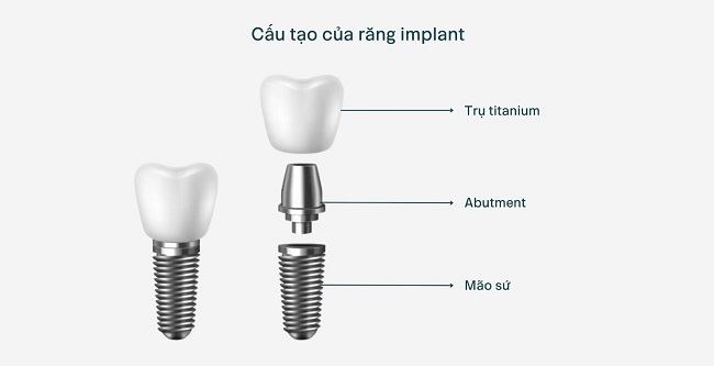 Abutment Implant là gì? Vai trò và các loại Abutment phổ biến 1 Abutment Implant là gì?