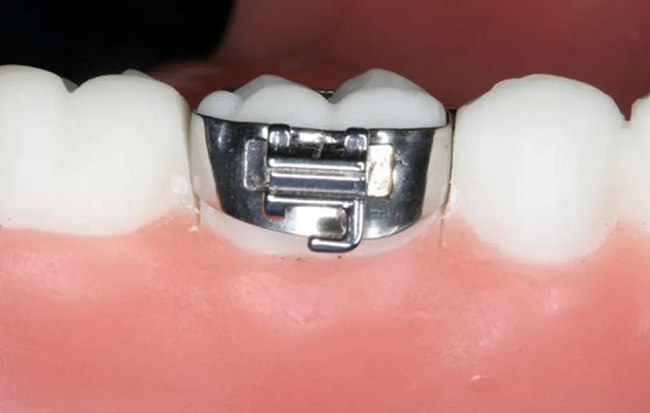 Band niềng răng là gì? Tác dụng và cách chăm sóc khi đeo band 2 Band niềng răng được đặt quanh thân răng hàm