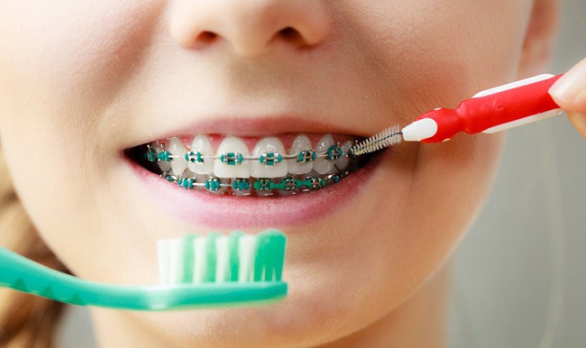 Band niềng răng là gì? Tác dụng và cách chăm sóc khi đeo band 5 Cách chăm sóc răng miệng khi đeo band niềng răng