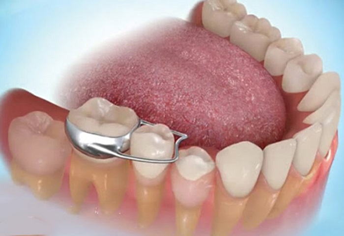 Band niềng răng là gì? Tác dụng và cách chăm sóc khi đeo band 1 Band niềng răng là các vòng kim loại được thiết kế để quấn vòng quanh răng hàm