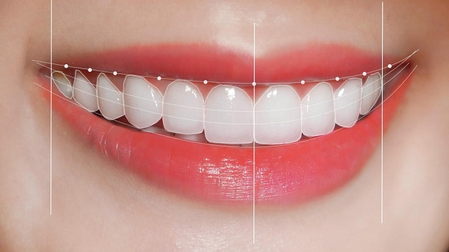 Bọc răng sứ emax có tốt không? Ưu và nhược điểm 2 Ưu điểm của bọc răng sứ Emax