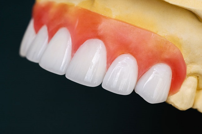 Bọc răng sứ emax có tốt không? Ưu và nhược điểm 3 Răng sứ Emax có thiết kế phù hợp, không gây ra tình trạng đen chân răng