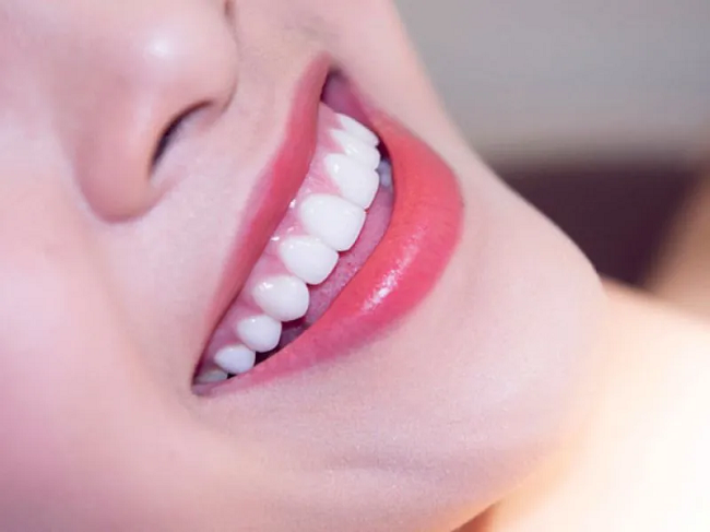 Bọc răng sứ emax có tốt không? Ưu và nhược điểm 4 Bọc răng sứ Emax phù hợp với những ai?