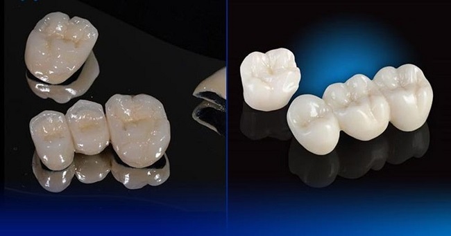 Bọc sứ răng hàm: Nên chọn loại nào để ăn nhai tốt? 3 Tiêu chí chọn răng sứ phù hợp cho răng hàm