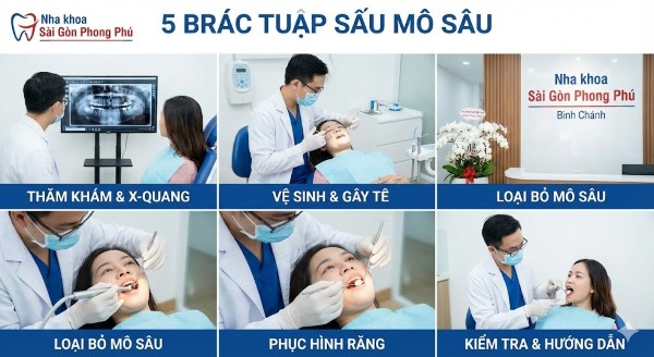 Quy trình trị sâu răng chuẩn y khoa tại Bình Chánh Quy trình trị sâu răng chuẩn y khoa tại Bình Chánh