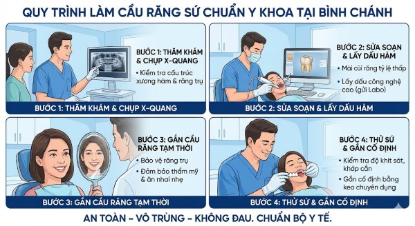 Cầu răng sứ là gì? Hướng dẫn chi tiết từ A đến Z cho người mới 5 Quy trình thực hiện cầu răng sứ tại nha khoa
