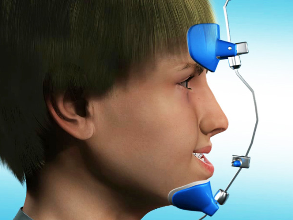 Facemask chỉnh nha: Giải pháp vàng cho răng móm, xương hàm hẹp 3 Facemask chỉnh nha dùng cho trường hợp răng móm do xương hàm