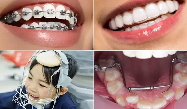 Facemask chỉnh nha: Giải pháp vàng cho răng móm, xương hàm hẹp 2 Độ tuổi nào đeo facemask chỉnh nha hiệu quả nhất?