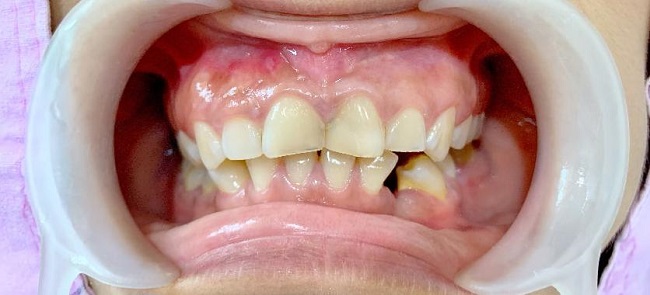 Khớp cắn chéo: Nguyên nhân, tác hại và cách điều trị 3 Nguyên nhân gây khớp cắn chéo