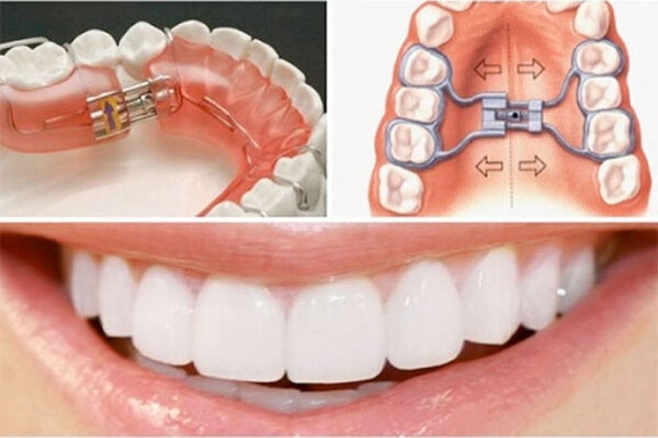 Khớp cắn chéo: Nguyên nhân, tác hại và cách điều trị 5 Niềng răng điều trị khớp cắn chéo