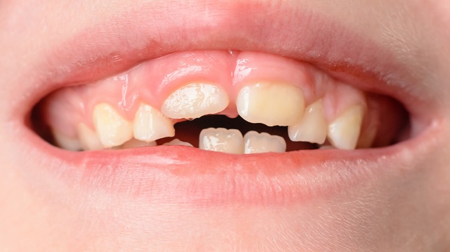 Khớp cắn chìa là gì? Phân biệt khớp cắn chìa và răng hô 2 Nguyên nhân gây khớp cắn chìa