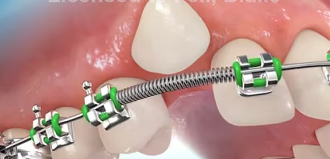 Lò xo chỉnh nha có tác dụng gì? Các loại lò xo phổ biến hiện nay 2 Lò xo mở giúp tạo ra khoảng trống giữa các răng bằng cách đẩy răng ra xa nhau