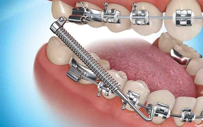 Lò xo chỉnh nha có tác dụng gì? Các loại lò xo phổ biến hiện nay 3 Lò Xo Kéo Chỉnh Nha