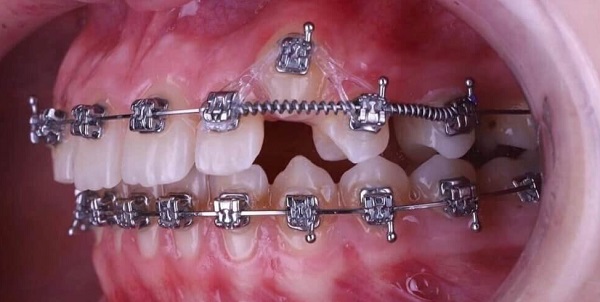 Lò xo chỉnh nha có tác dụng gì? Các loại lò xo phổ biến hiện nay 1 Lò xo chỉnh nha