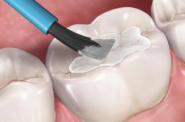 Trám răng - Giải pháp điều trị sâu răng triệt để tại Nha khoa Sài Gòn Phong Phú Trám răng - Giải pháp điều trị sâu răng triệt để tại Nha khoa Sài Gòn Phong Phú