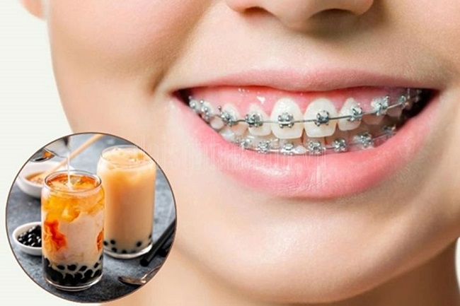 Niềng răng uống trà sữa được không? Lưu ý để không bung mắc cài 5 Chế độ ăn uống đóng vai trò quyết định 30–40% thành công của quá trình niềng răng