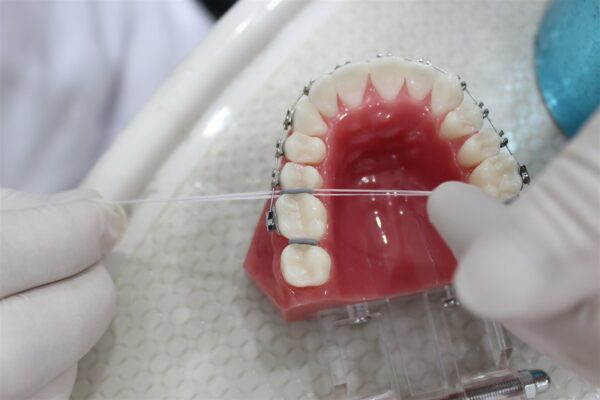 Thun tách kẽ răng: Đeo trong bao lâu và cách giảm đau 2 Thun tách kẽ răng hỗ trợ quá trình chỉnh nha diễn ra thuận lợi