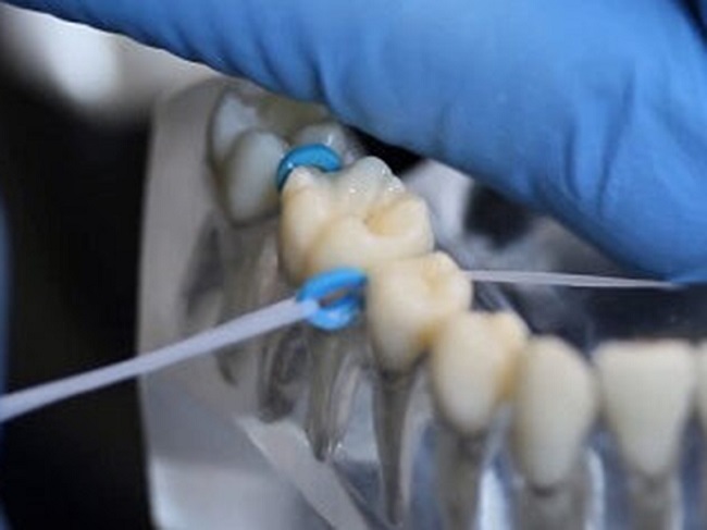 Thun tách kẽ răng: Đeo trong bao lâu và cách giảm đau 3 Thời gian đeo thun tách kẽ trung bình