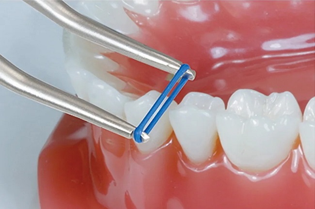 Thun tách kẽ răng: Đeo trong bao lâu và cách giảm đau 6 thun tách kẽ răng