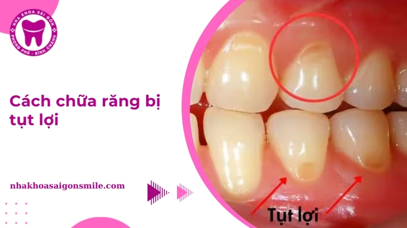 7 Cách chữa răng bị tụt lợi hiệu quả, an toàn chuẩn y khoa - Nha khoa ...