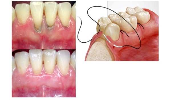 7 Cách chữa răng bị tụt lợi hiệu quả, an toàn chuẩn y khoa 8 Phẫu thuật ghép mô lợi cho trường hợp tụt lợi nghiêm trọng