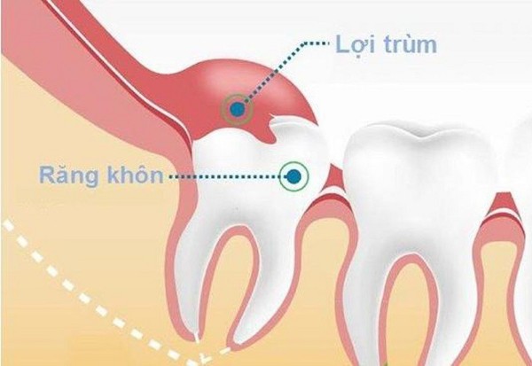 Cắt lợi trùm là gì? Bảng giá và lưu ý quan trọng từ Bác sĩ 1 Cắt lợi trùm là thủ thuật nha khoa giúp loại bỏ phần lợi thừa