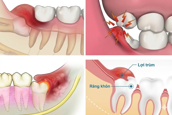 Cắt lợi trùm là gì? Bảng giá và lưu ý quan trọng từ Bác sĩ 2 Quyết định cắt lợi trùm dựa trên tình trạng thực tế của từng cá nhân