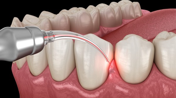 Cắt lợi trùm là gì? Bảng giá và lưu ý quan trọng từ Bác sĩ 3 Cắt lợi trùm bằng laser