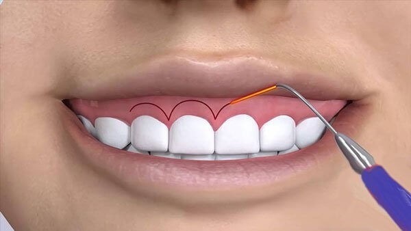 Cắt lợi trùm là gì? Bảng giá và lưu ý quan trọng từ Bác sĩ 4 Phương pháp cắt lợi trùm bằng điện