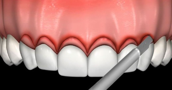Cắt lợi trùm là gì? Bảng giá và lưu ý quan trọng từ Bác sĩ 5 Cắt lợi trùm bằng phương pháp phẫu thuật truyền thống