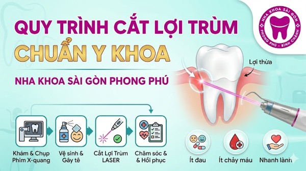 Cắt lợi trùm là gì? Bảng giá và lưu ý quan trọng từ Bác sĩ 6 Quy trình cắt lợi trùm chuẩn Y khoa tại Nha khoa Sài Gòn Phong Phú